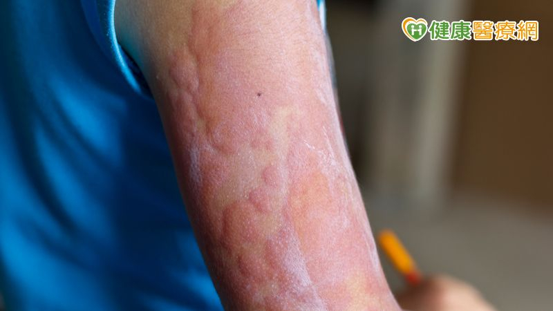 小一學生因異位性皮膚炎重度發作而不敢上學！「精準治療」幫助找回自信，重返校園